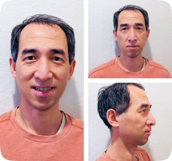 Collage of a Lai Orthodontics patient's photos