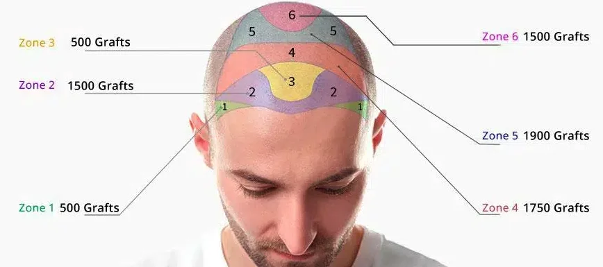 Hair Transplant Grafts
