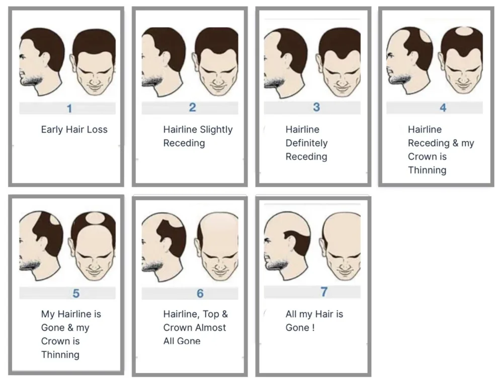 Hairline Options