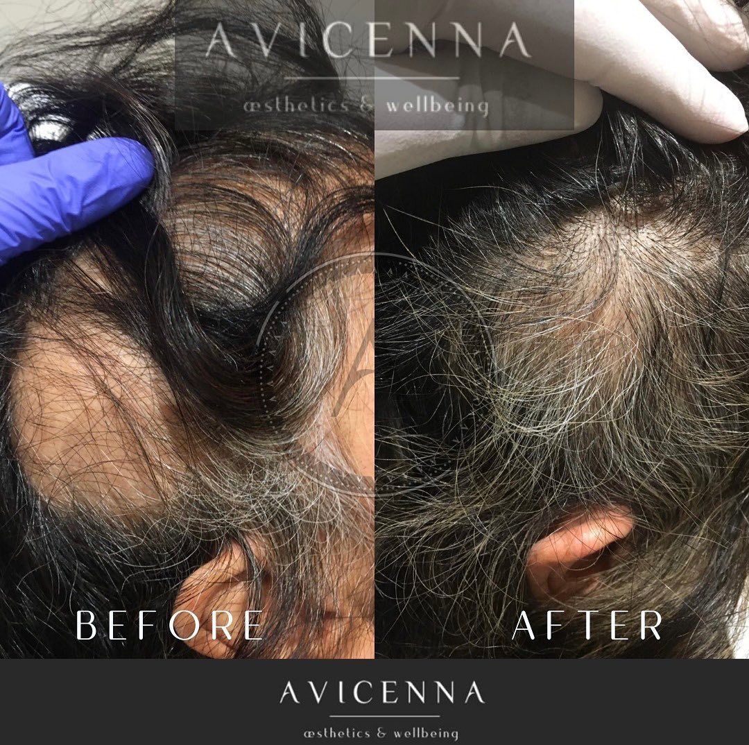 Before and after a full course of PRP hair restoration at Avicenna Wellbeing