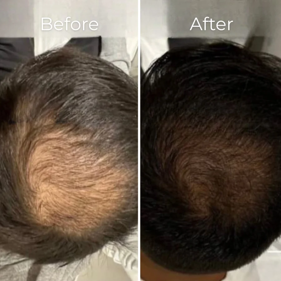 Before and after a full course of PRP hair restoration at Avicenna Wellbeing