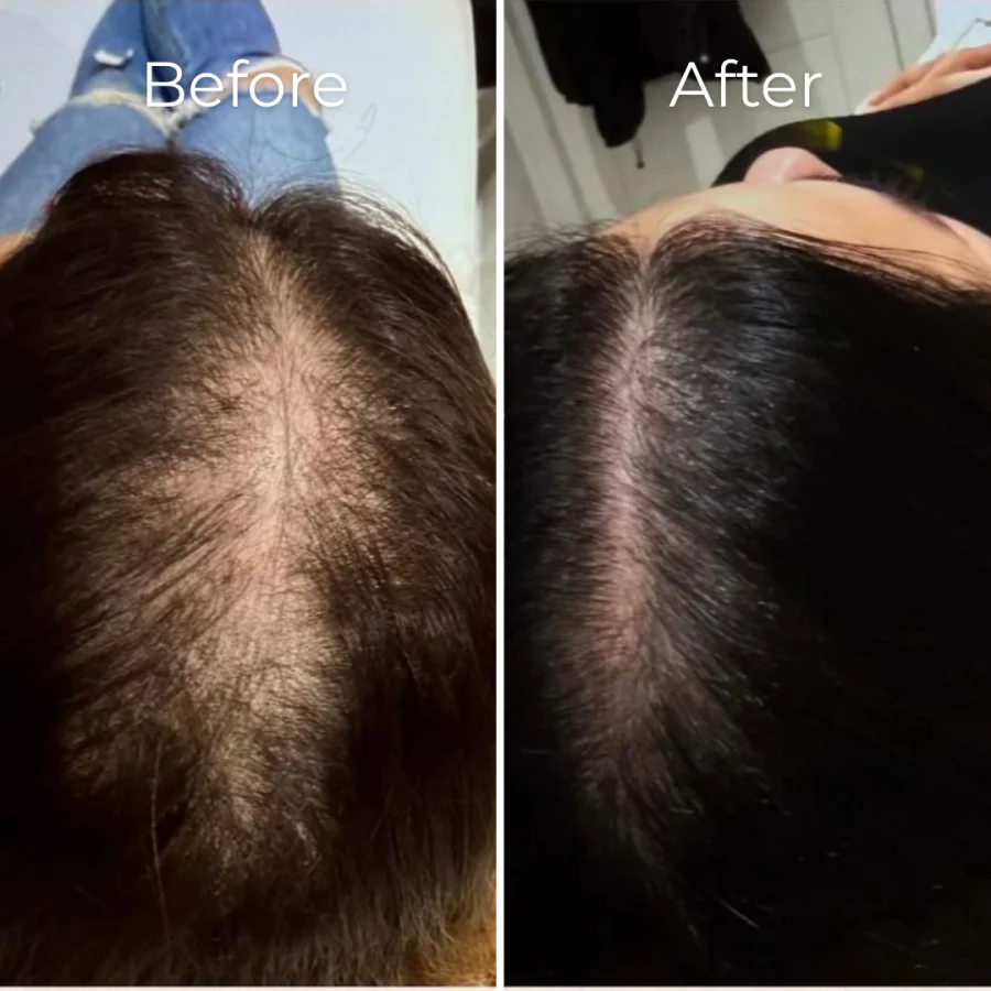 Before and after a full course of PRP hair restoration at Avicenna Wellbeing
